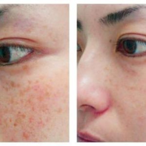 Laser Brown Spot Treatments