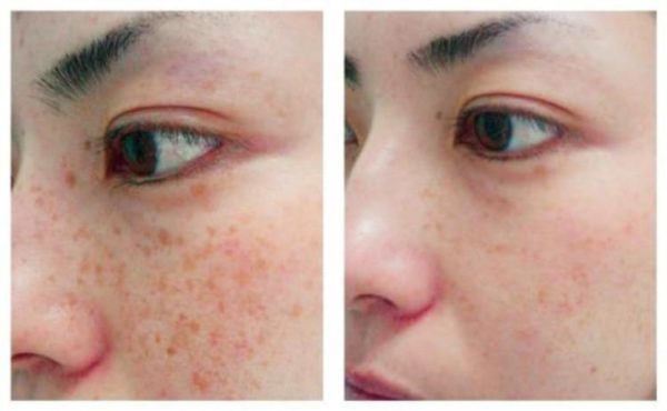 Laser Brown Spot Treatments