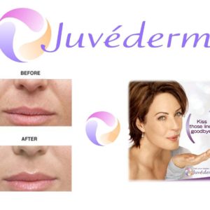 Juvederm