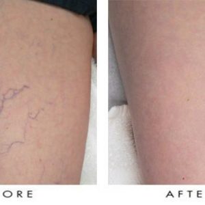 Laser Spider Vein Treatments