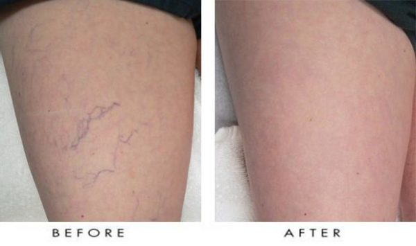 Laser Spider Vein Treatments