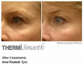 ThermiSmooth  Skin Tightening for fine lines/wrinkles around eyes OR mouth (4 txs) 40 FREE UNITS OF BOTOX