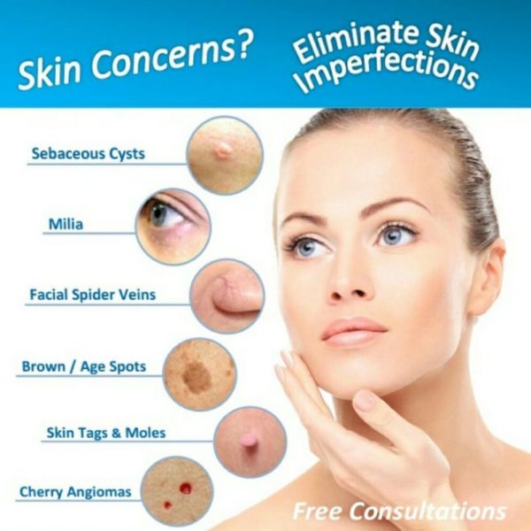 Skin Care, spider veins, freezepen, laser treatments